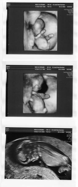 Bild zu Zum Aufbauen...Meine NT-Messung heute mit Foto - Forum für Juni - Mamis