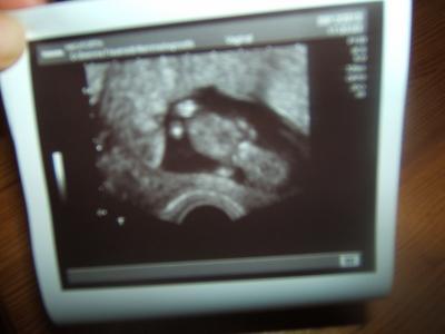 Bild zu zurück vom gyn und erste outing prognose :=) - Forum für Juni - Mamis