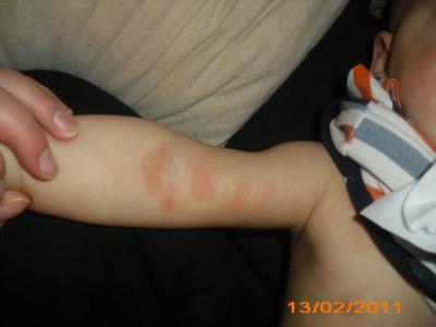 Bild zu Hat einer eurer Kinder Neurodermitis oder ihr selbst? - Forum für Juni - Mamis