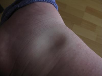 Bild zu Soviel Wasser in den Beinen und Füßen das ist kaum laufen kann - Forum für Juni - Mamis