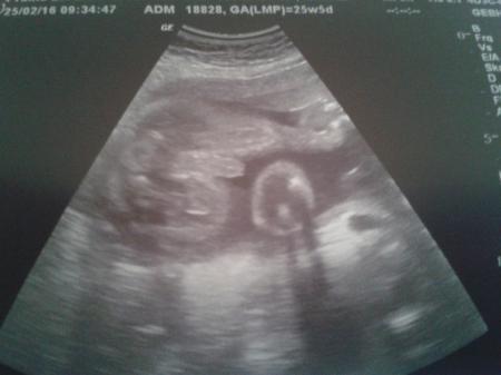 Bild zu Gestern VU plus Ultraschallbild - Forum für Juni - Mamis