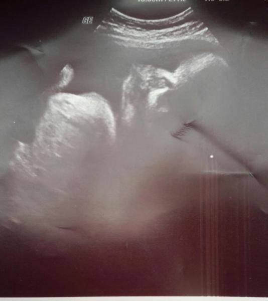 Bild zu Ultraschallbild - Forum für Juni - Mamis