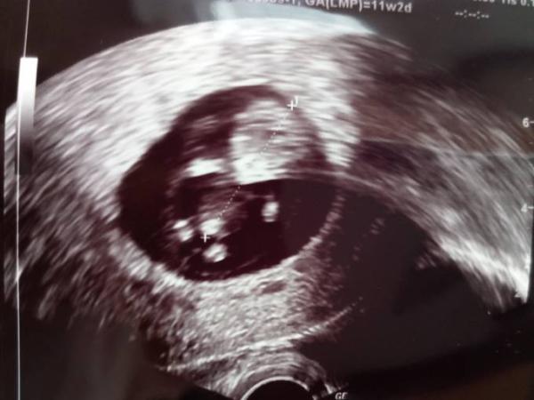 Bild zu Noch Bericht von Montag nachreich... - Forum für Juni - Mamis