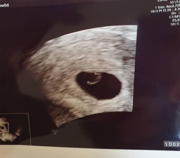 Bild zu Ultraschall deutenđ - Forum fĂŒr Juni - Mamis