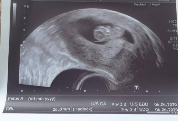 Bild zu Erleichtert. Stechender Schmerz im Unterleib - Forum für Juni - Mamis