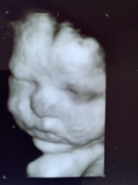 Bild zu Letztes Screening und 3D Ultraschall - Forum für Juni - Mamis