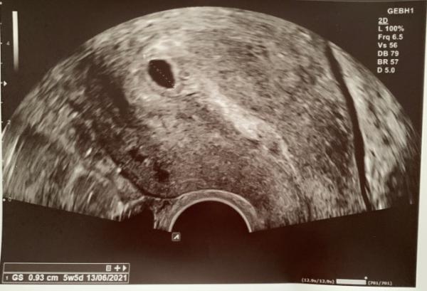 Bild zu 5+1 nur leere Fruchthöhle - Forum für Juni - Mamis