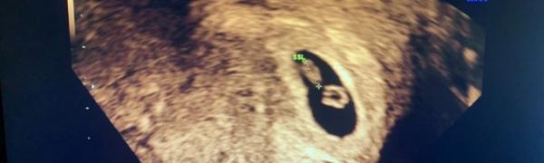 Bild zu Ultraschall 😍 - Forum für Juni - Mamis