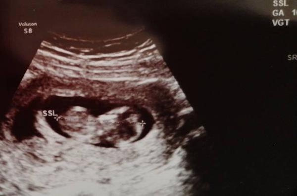 Bild zu 2 Ultraschall - Forum für Juni - Mamis