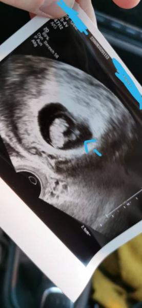 Bild zu Ultraschall - Forum für Juni - Mamis