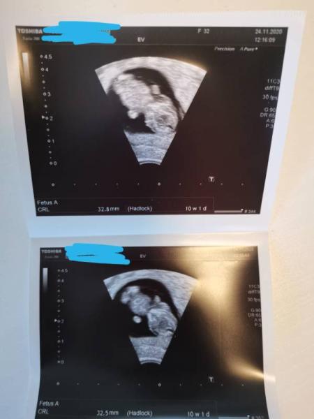 Bild zu 2. Ultraschall - Forum für Juni - Mamis