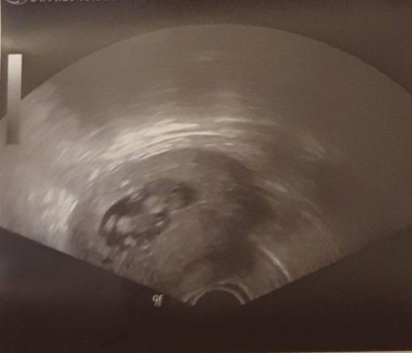 Bild zu 2. Kontrolluntersuchung - Forum für Juni - Mamis