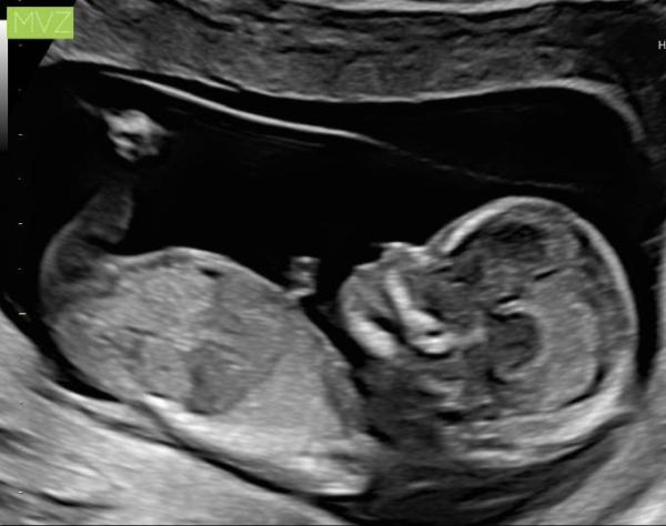 Bild zu Nackenfaltenmessung und Outing - Forum für Juni - Mamis