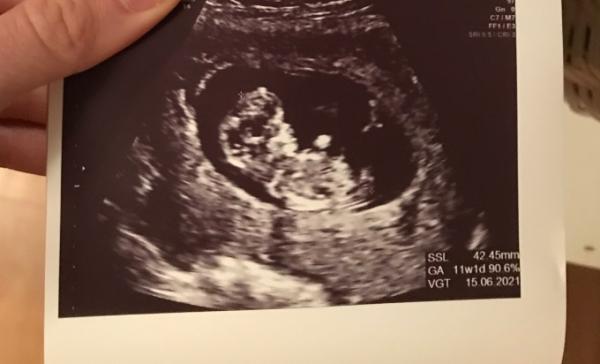 Bild zu US und Nackenfaltmessung - Forum für Juni - Mamis