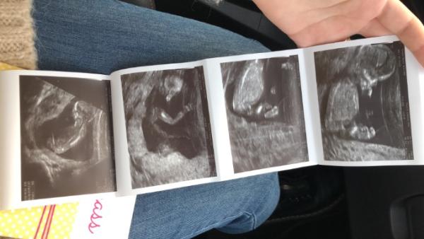 Bild zu Nackenfaltenmessung ❤️ - Forum für Juni - Mamis