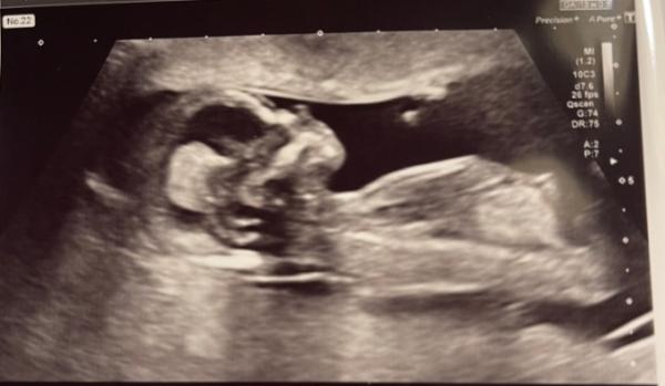 Bild zu Ersttrimmester Ultraschall 🍀 - Forum für Juni - Mamis