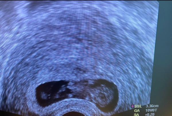 Bild zu Überglücklich vom Ultraschall zurück - Forum für Juni - Mamis