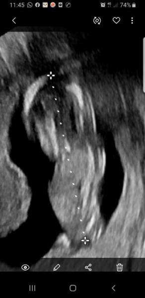 Bild zu 14+ 4 embyo zu klein - Forum für Juni - Mamis