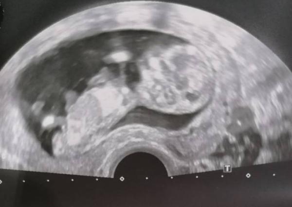 Bild zu Ultraschall 13. SSW - Forum für Juni - Mamis