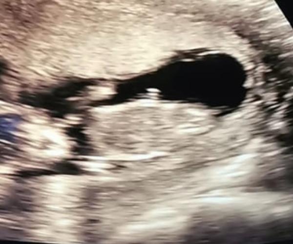 Bild zu Ultraschall - Forum für Juni - Mamis