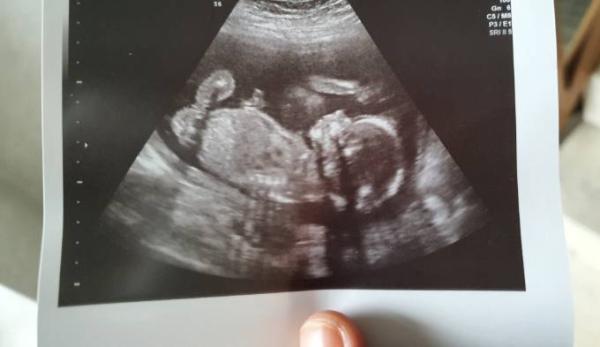 Bild zu Ultraschallbild verstehen - Forum für Juni - Mamis