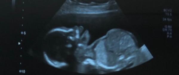 Bild zu Eure Lieblingsultraschallbilder ❤️ - Forum für Juni - Mamis