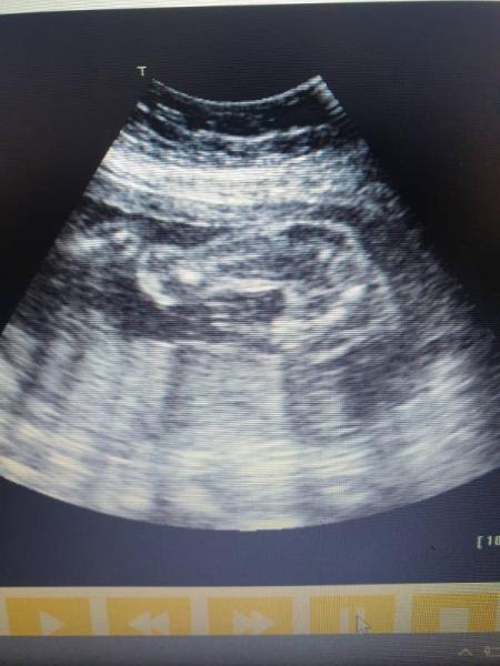 Bild zu Babywatcher Geschlecht 25 SSW - Forum für Juni - Mamis