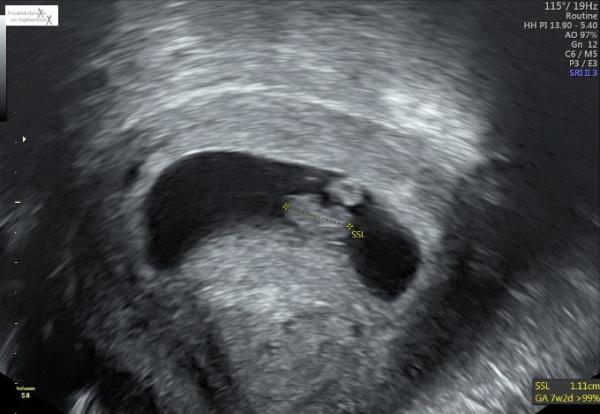 Bild zu Erster Ultraschall - Forum für Juni - Mamis