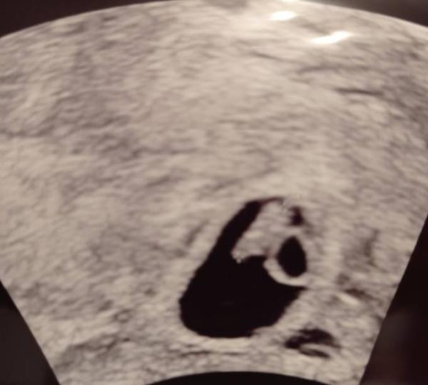 Bild zu 2. Termin früher als gedacht - Forum für Juni - Mamis