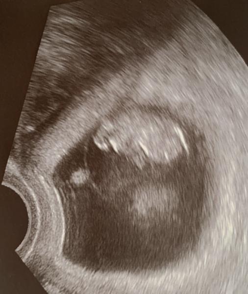 Bild zu Erst Trimester Untersuchung geschafft - Forum für Juni - Mamis