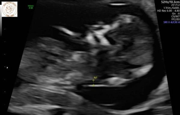 Bild zu Ersttrimester Screening - Forum für Juni - Mamis