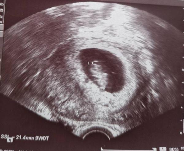 Bild zu Wegen Schmerzen 2. US - Forum für Juni - Mamis
