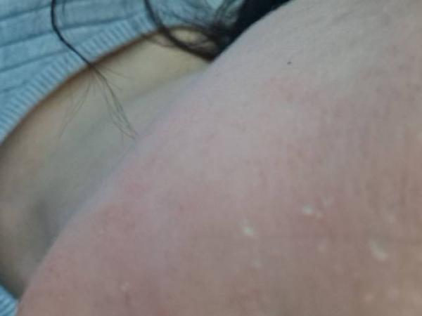 Bild zu Hautprobleme - Forum für Juni - Mamis