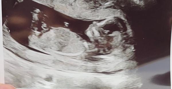Bild zu Ultraschall Bild -> Geschlechtsvermutung - Forum für Juni - Mamis