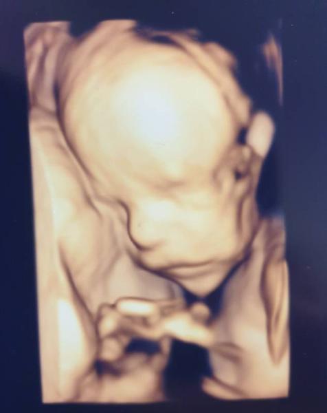Bild zu Ultraschallbilder - Forum für Juni - Mamis