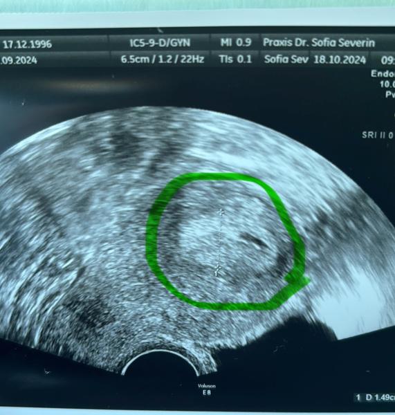 Bild zu Blutungen SSW 5+1 - Forum für Juni - Mamis
