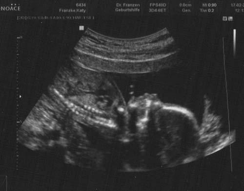 Bild zu keine Kindbew.in 18Ssw heute Termin gehabt+Foto - Forum für Juli - Mamis