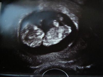 Bild zu Ultraschallbilder 11 SSW erkennt ihr das Geschlecht? - Forum für Juli - Mamis