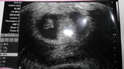 Bild zu Ultraschallbilder - Forum für Juli - Mamis