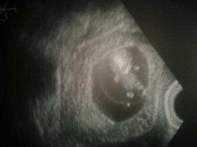 Bild zu Ultraschall 10+0 - Forum für Juli - Mamis