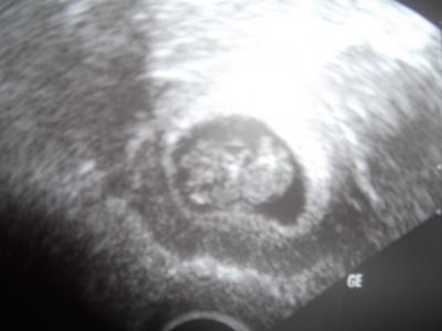 Bild zu Ausserplanmäßiger Arztbesuch - Blutung - Forum für Juli - Mamis