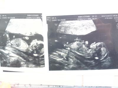 Bild zu bericht vom ersttrimesterscreening... - Forum für Juli - Mamis