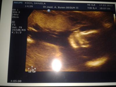 Bild zu Zurück von der Feindiagnostig + Outing mega glücklich - Forum für Juli - Mamis