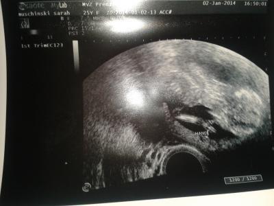 Bild zu UltraschallBild - Forum für Juli - Mamis