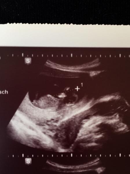 Bild zu 12ssw und noch keine vaginale Untersuchung trotz 2 fA termine - Forum für Juli - Mamis