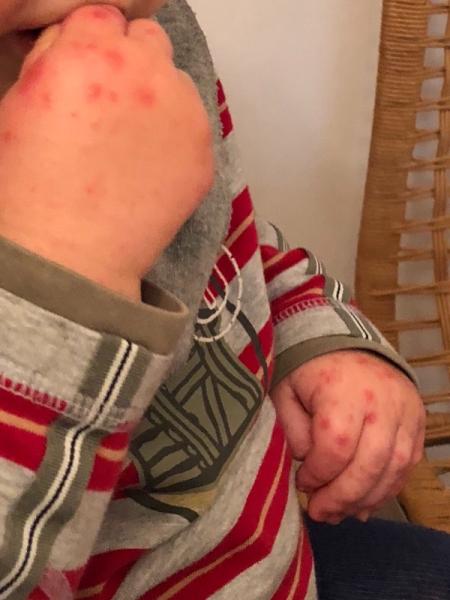 Bild zu Hand Mund Fuß, was hilft? - Forum für Juli - Mamis