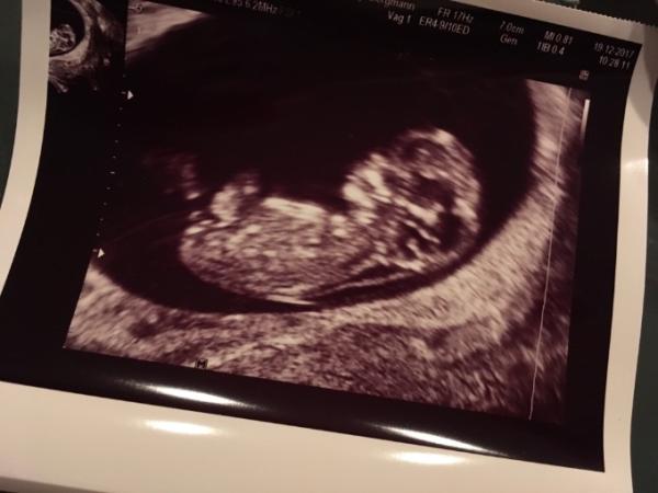 Bild zu Sorge nach Ultraschall - Forum für Juli - Mamis