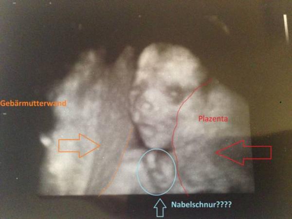 Bild zu Nabelschnur um den Hals? Ob das ein Problem wird? - Forum für Juli - Mamis