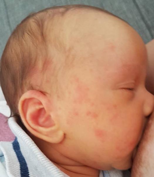 Bild zu Unruhe, Babyakne und Co - Forum für Juli - Mamis