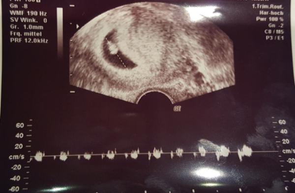 Bild zu Gestern Ultraschall beim FA - Forum für Juli - Mamis